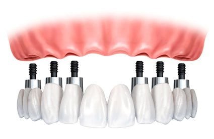 implant dentar